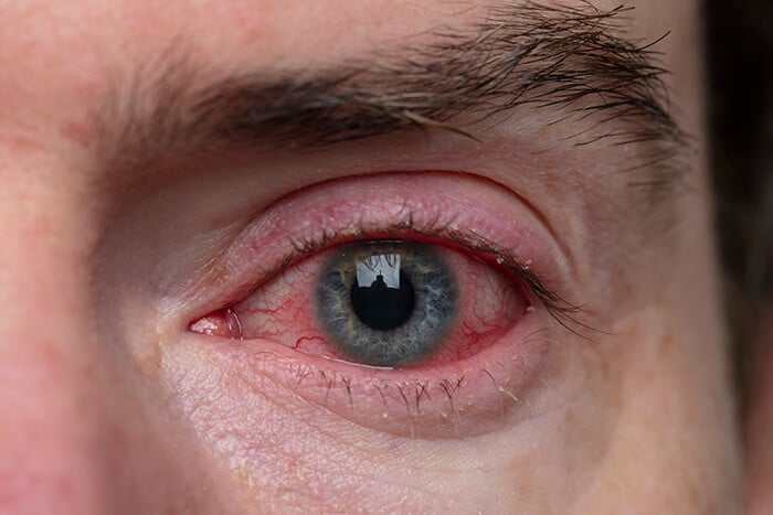 Closeup of an Irritated Eye With Blepharitis