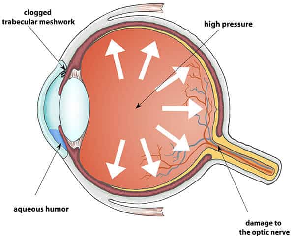 Chart Illustrating How Glaucoma Affects an Eye