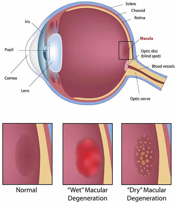 Chart showing how wet and dry macular degeneration affect an eye