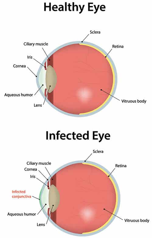 Chart illustrating a healthy eye compared to one that is infected